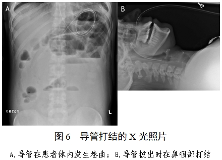 經(jīng)鼻腸營(yíng)養(yǎng)導(dǎo)管注冊(cè)審查指導(dǎo)原則（2022年第41號(hào)）(圖5)